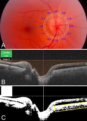 Peripapillary Choroidal Vascularity and Visual Correlates in Non-Arteritic Anterior Ischemic Optic Neuropathy Using Swept-Source Optical Coherence Tomography